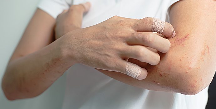 Les procès inflammatoires sur le psoriasis