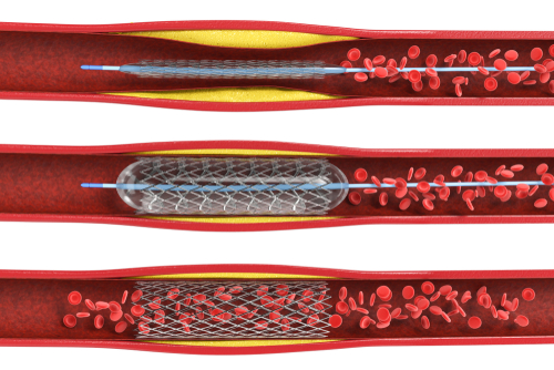 Cœur : méfiez-vous des stents